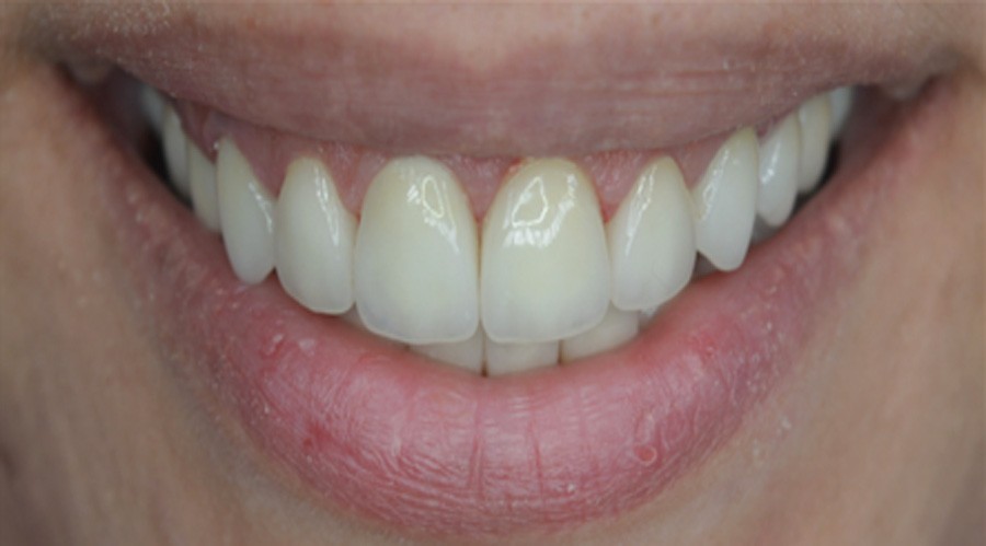 بعد تجميل وعلاج اللثة مركز دكتور ايمن الغمراوى لطب الاسنان 6